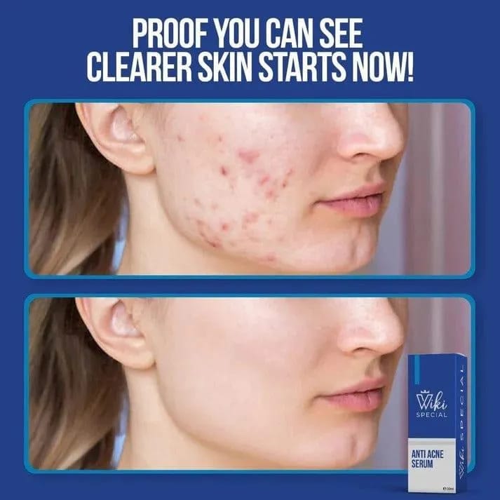 Anti Acne Serum 30ml |Skin Care|